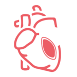 Cardiomiopatía isquémica